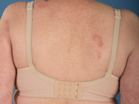 Eosinophilic annular erythema