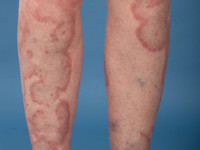 Eosinophilic annular erythema