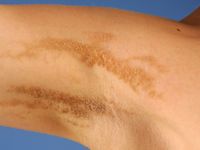 Epidermal nevus syndrome