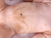 Epidermal nevus syndrome