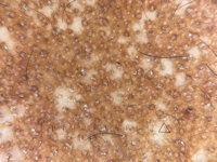 Acquired epidermodysplasia verruciformis