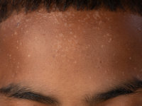 Acquired epidermodysplasia verruciformis