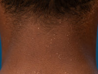 Acquired epidermodysplasia verruciformis