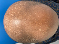 Acquired epidermodysplasia verruciformis