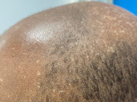 Acquired epidermodysplasia verruciformis