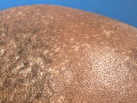 Acquired epidermodysplasia verruciformis