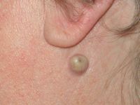 Epidermoidcyste, atheroomcyste