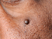 Epidermoidcyste, atheroomcyste