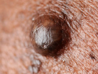 Epidermoidcyste, atheroomcyste