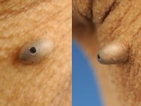 Epidermoidcyste, atheroomcyste