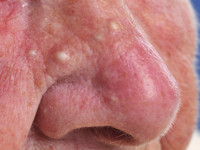 Epidermoidcyste, atheroomcyste