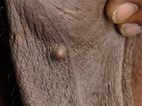 Epidermoidcyste, atheroomcyste