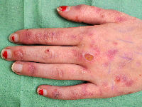 Epidermolysis bullosa acquisita