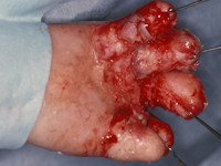 Dystrofische epidermolysis bullosa