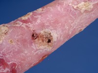 Dystrofische epidermolysis bullosa