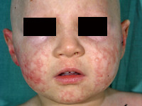 Epidermolysis bullosa