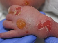 Junctional epidermolysis bullosa
