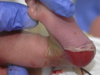 Junctional epidermolysis bullosa