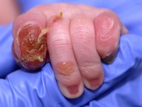 Epidermolysis bullosa simplex