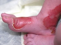 Epidermolysis bullosa simplex