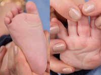 Epidermolysis bullosa simplex