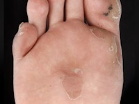 Epidermolysis bullosa simplex Weber-Cockayne type