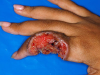 Epitheloid sarcoma