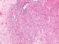 Epitheloid sarcoma