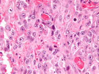 Epitheloid sarcoma