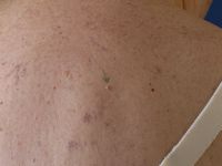 Sebaceous epithelioma