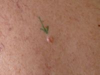 Sebaceous epithelioma