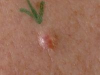 Sebaceous epithelioma