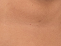 Epithelioid fibrous histiocytoma