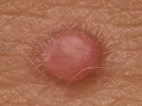 Epithelioid fibrous histiocytoma