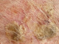 Erosive pustular dermatosis of the scalp