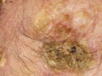 Erosive pustular dermatosis of the scalp