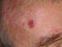 Erosive pustular dermatosis of the scalp