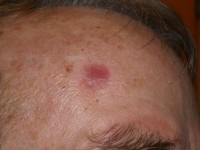 Erosive pustular dermatosis of the scalp