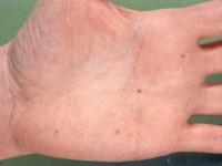 Eruptieve acrale naevi bij ciclosporine en prednison voor donornier