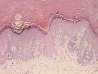 Eruptieve acrale naevi bij ciclosporine en prednison voor donornier