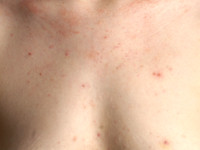 Eruptieve vellushaar cysten