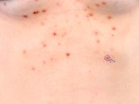 Eruptieve vellushaar cysten