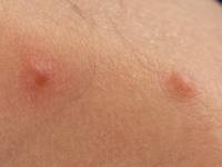 Eruptieve vellushaar cysten