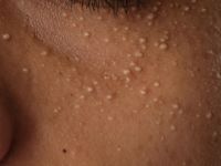 Eruptieve vellushaar cysten