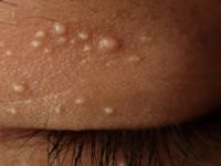 Eruptieve vellushaar cysten