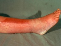 Erysipelas, erysipelas, erysipelas