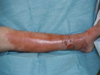 Erysipelas, erysipelas, erysipelas