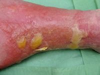 Erysipelas, erysipelas, erysipelas