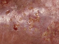 Erysipelas, erysipelas, erysipelas