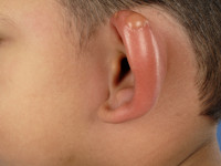 Erysipelas in het gelaat